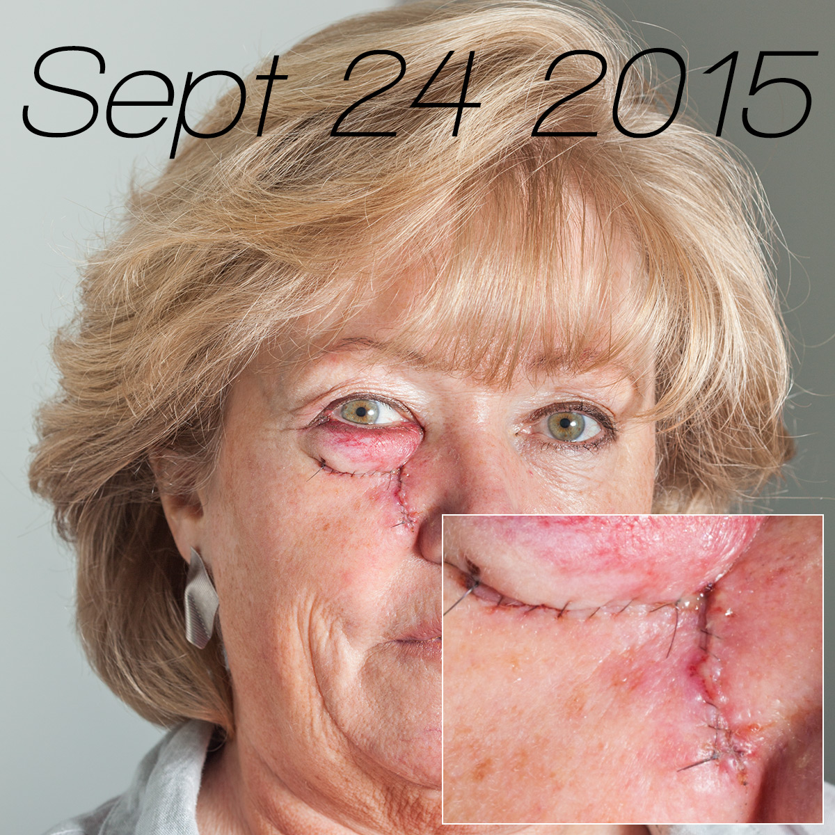 Stitches following Mohs surgery September 23 2015